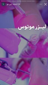 لیزر موهای زائد کلینیک مریم در مشهد