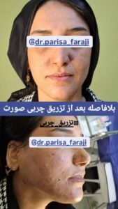 نمونه تزریق چربی (دکتر پریسا فرجی)