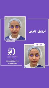 نمونه تزریق چربی (دکتر نعیمه ارگنجی)