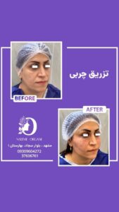نمونه تزریق چربی (دکتر نعیمه ارگنجی)