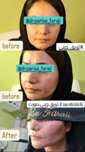نمونه تزریق چربی (دکتر پریسا فرجی)