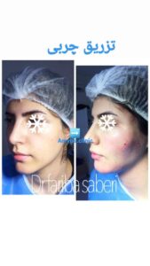 نمونه تزریق چربی (دکتر فریبا صابری)