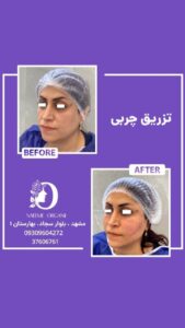 نمونه تزریق چربی (دکتر نعیمه ارگنجی)