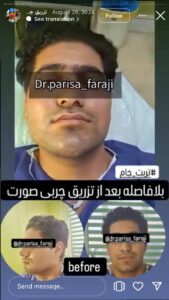 نمونه تزریق چربی (دکتر پریسا فرجی)