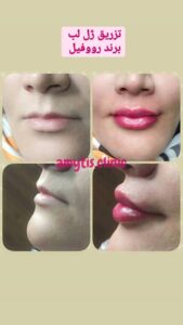 نمونه تزریق چربی (دکتر فریبا صابری)