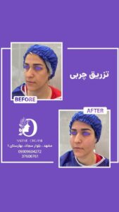 نمونه تزریق چربی (دکتر نعیمه ارگنجی)