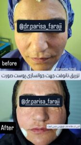 نمونه تزریق چربی (دکتر پریسا فرجی)