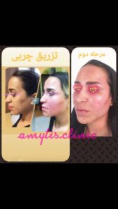 نمونه تزریق چربی (دکتر فریبا صابری)