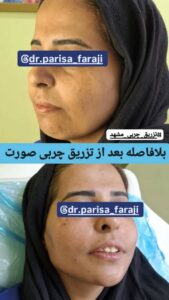 نمونه تزریق چربی (دکتر پریسا فرجی)
