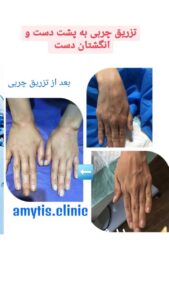 نمونه تزریق چربی (دکتر فریبا صابری)