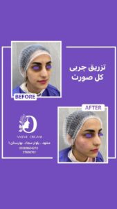 نمونه تزریق چربی (دکتر نعیمه ارگنجی)
