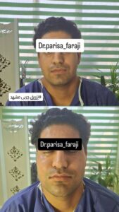 نمونه تزریق چربی (دکتر پریسا فرجی)