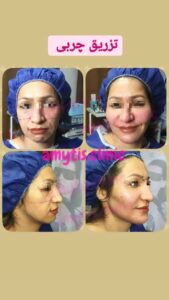 نمونه تزریق چربی (دکتر فریبا صابری)