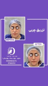 نمونه تزریق چربی (دکتر نعیمه ارگنجی)