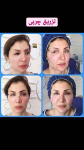 نمونه تزریق چربی (دکتر فریبا صابری)
