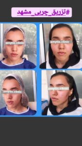 نمونه تزریق چربی (دکتر فریبا صابری)