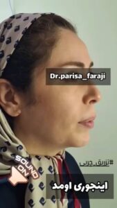 نمونه تزریق چربی (دکتر پریسا فرجی)