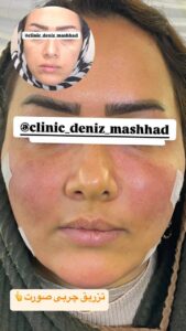 نمونه تزریق چربی (کلینیک دنیز)