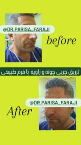 نمونه تزریق چربی (دکتر پریسا فرجی)