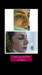 نمونه تزریق چربی (دکتر نازنین ابدالی)