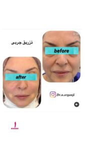 نمونه تزریق چربی (دکتر نعیمه ارگنجی)