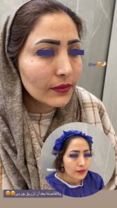 نمونه تزریق چربی (دکتر نعیمه ارگنجی)