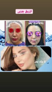 نمونه تزریق چربی (دکتر فریبا صابری)