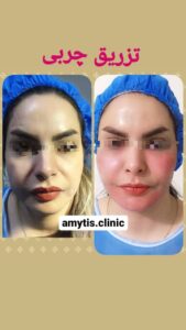نمونه تزریق چربی (دکتر فریبا صابری)