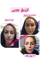 نمونه تزریق چربی (دکتر فریبا صابری)