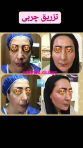 نمونه تزریق چربی (دکتر فریبا صابری)