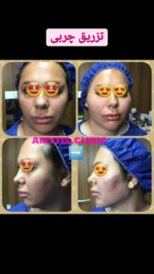 نمونه تزریق چربی (دکتر فریبا صابری)