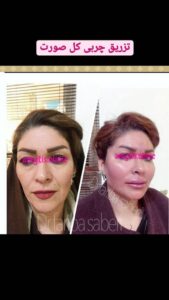 نمونه تزریق چربی (دکتر فریبا صابری)