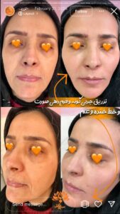 نمونه تزریق چربی (کلینیک سی گل)