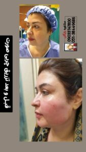 نمونه تزریق چربی (کلینیک دنیز)