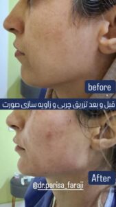نمونه تزریق چربی (دکتر پریسا فرجی)