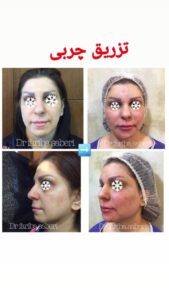 نمونه تزریق چربی (دکتر فریبا صابری)