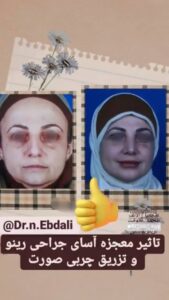 نمونه تزریق چربی (دکتر نازنین ابدالی)