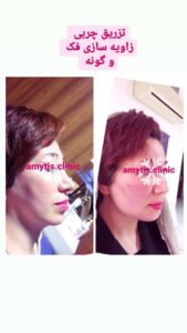نمونه تزریق چربی (دکتر فریبا صابری)