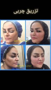 نمونه تزریق چربی (دکتر فریبا صابری)