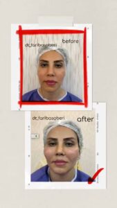 نمونه تزریق چربی (دکتر فریبا صابری)