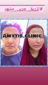 نمونه تزریق چربی (دکتر فریبا صابری)