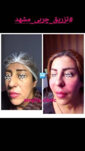 نمونه تزریق چربی (دکتر فریبا صابری)