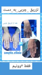 نمونه تزریق چربی (دکتر فریبا صابری)