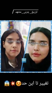 نمونه تزریق چربی (دکتر فریبا صابری)