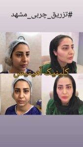 نمونه تزریق چربی (دکتر فریبا صابری)