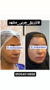 نمونه تزریق چربی (دکتر فریبا صابری)