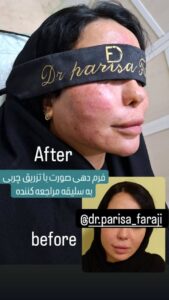 نمونه تزریق چربی (دکتر پریسا فرجی)