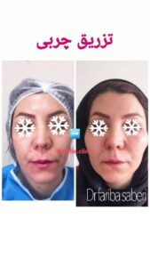 نمونه تزریق چربی (دکتر فریبا صابری)