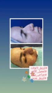 نمونه تزریق چربی (دکتر نازنین ابدالی)