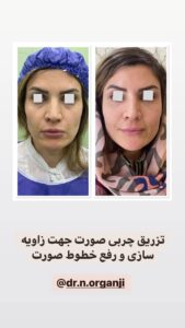 نمونه تزریق چربی (دکتر نعیمه ارگنجی)
